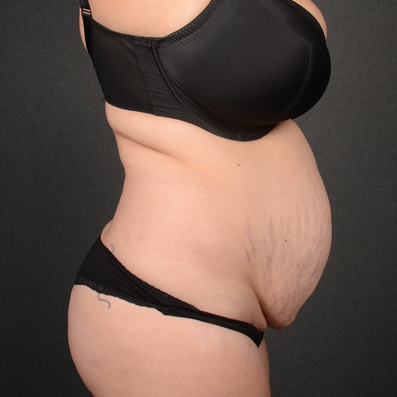 Tummy Tuck Before & After Gallery - Patient 391961 - Image 5