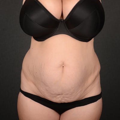 Tummy Tuck Before & After Gallery - Patient 391961 - Image 1