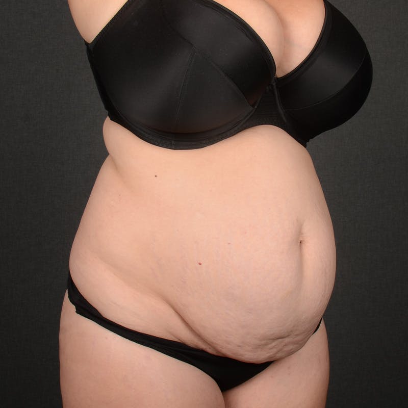 Tummy Tuck Before & After Gallery - Patient 391961 - Image 3