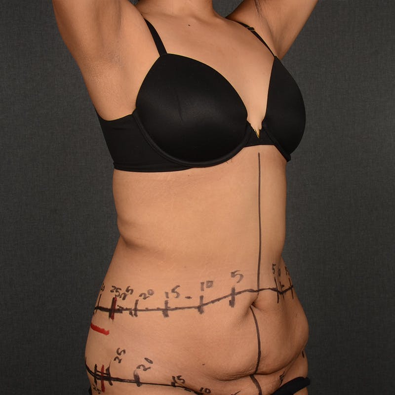 Tummy Tuck Before & After Gallery - Patient 836082 - Image 3