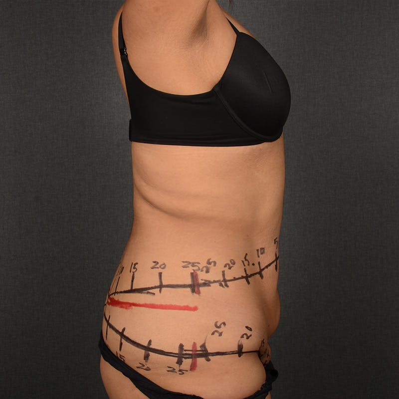 Tummy Tuck Before & After Gallery - Patient 836082 - Image 5