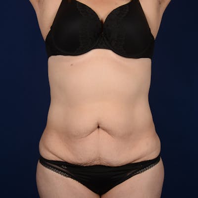 Tummy Tuck Before & After Gallery - Patient 155901 - Image 1