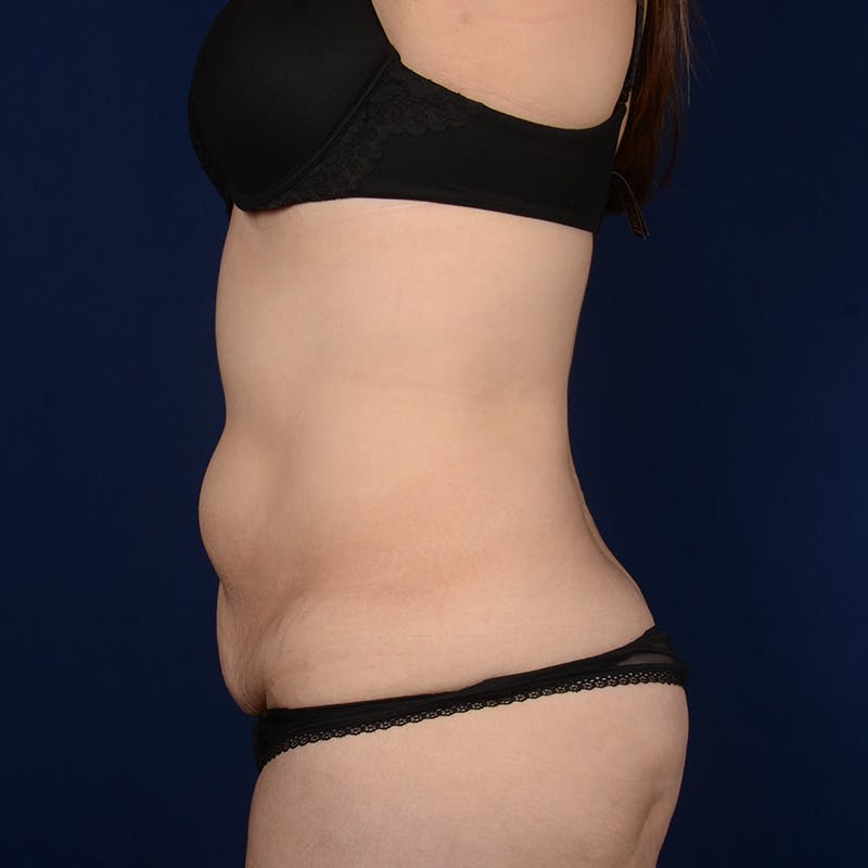 Tummy Tuck Before & After Gallery - Patient 155901 - Image 5
