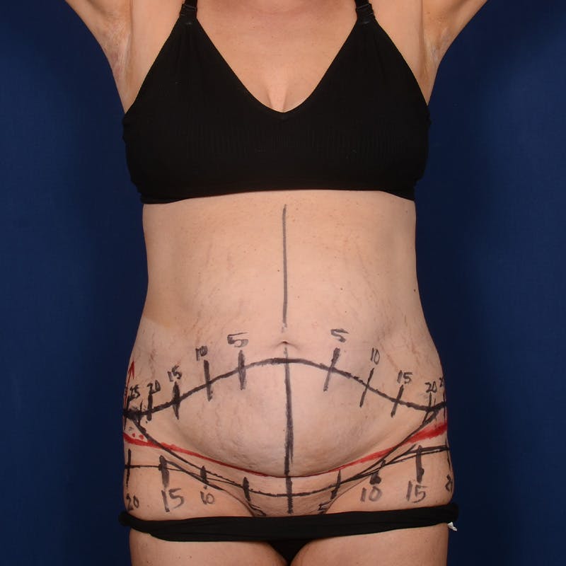 Tummy Tuck Before & After Gallery - Patient 196686 - Image 1