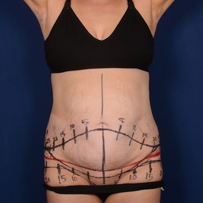 Tummy Tuck Before & After Gallery - Patient 196686 - Image 1