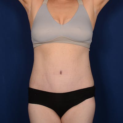 Tummy Tuck Before & After Gallery - Patient 196686 - Image 2