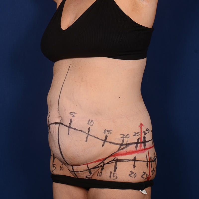 Tummy Tuck Before & After Gallery - Patient 196686 - Image 3