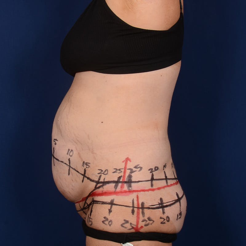 Tummy Tuck Before & After Gallery - Patient 196686 - Image 5