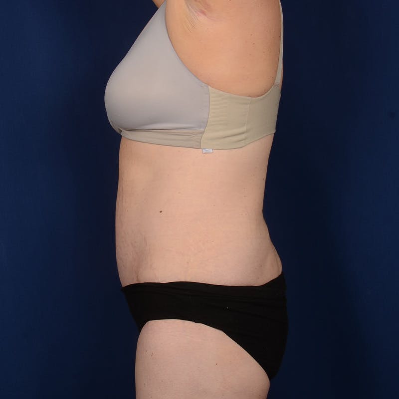 Tummy Tuck Before & After Gallery - Patient 196686 - Image 6