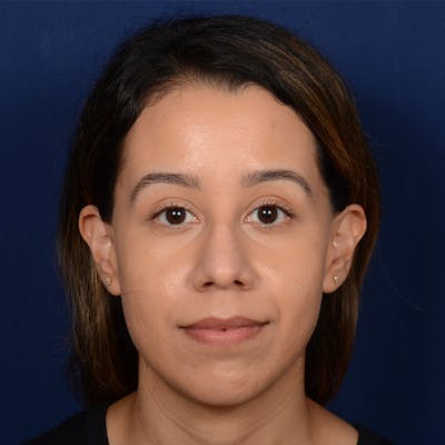 Chin Augmentation Before & After Gallery - Patient 619276 - Image 1
