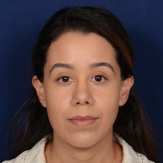 Chin Augmentation Before & After Gallery - Patient 619276 - Image 2