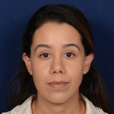 Chin Augmentation Before & After Gallery - Patient 619276 - Image 2
