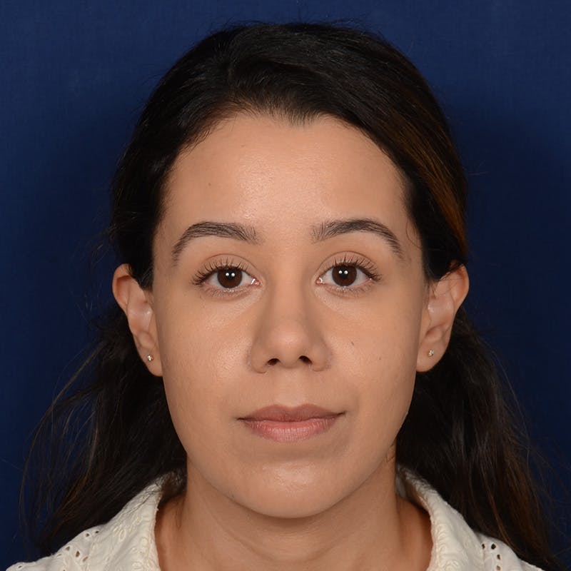 Chin Augmentation Before & After Gallery - Patient 619276 - Image 2