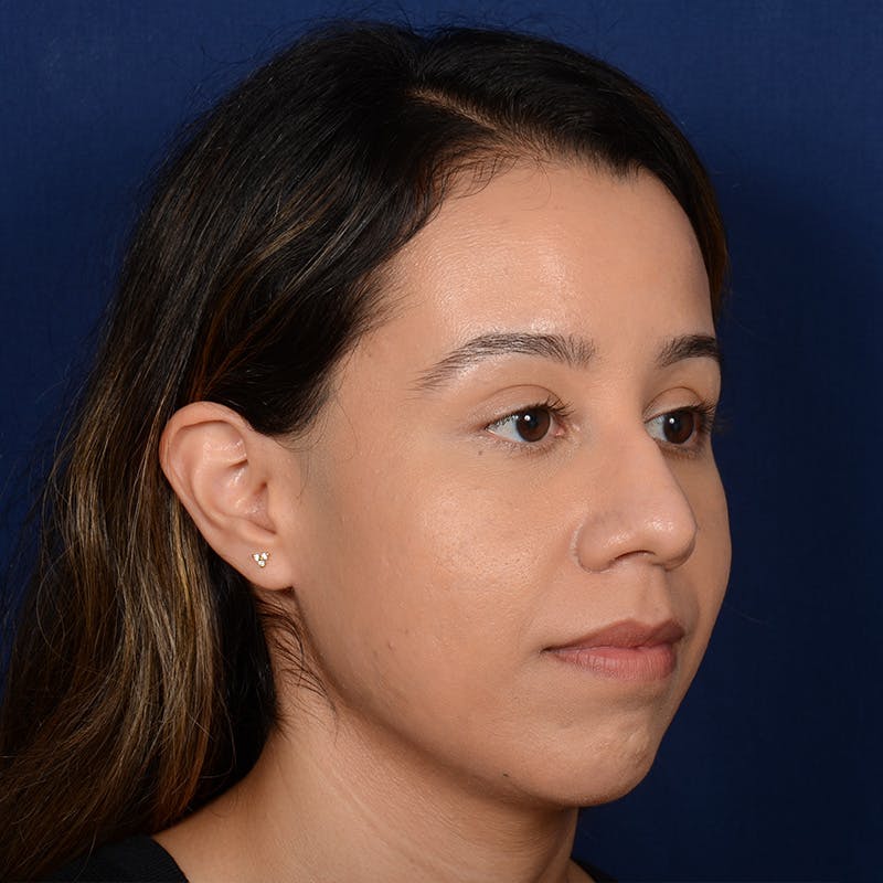 Chin Augmentation Before & After Gallery - Patient 619276 - Image 3