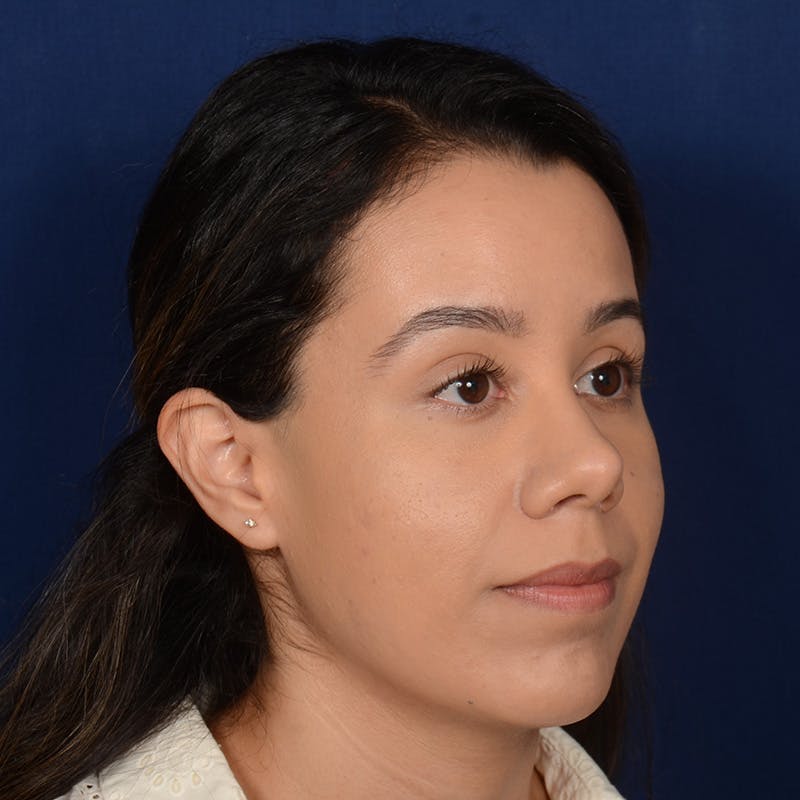 Chin Augmentation Before & After Gallery - Patient 619276 - Image 4