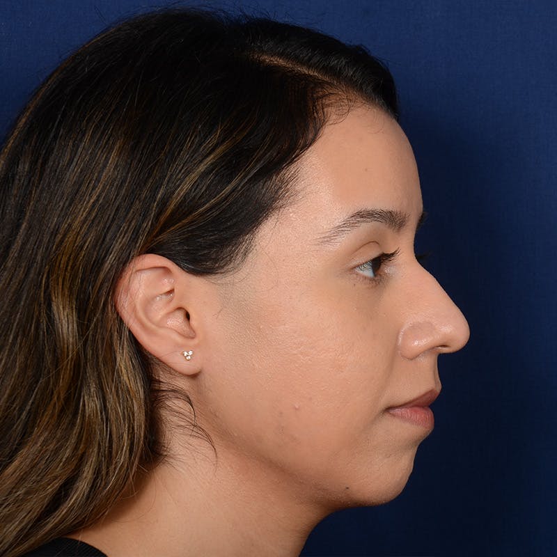 Chin Augmentation Before & After Gallery - Patient 619276 - Image 5