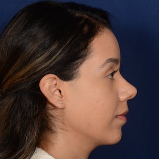 Chin Augmentation Before & After Gallery - Patient 619276 - Image 6