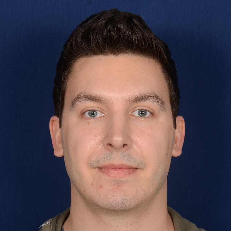 Chin Augmentation Before & After Gallery - Patient 363118 - Image 2