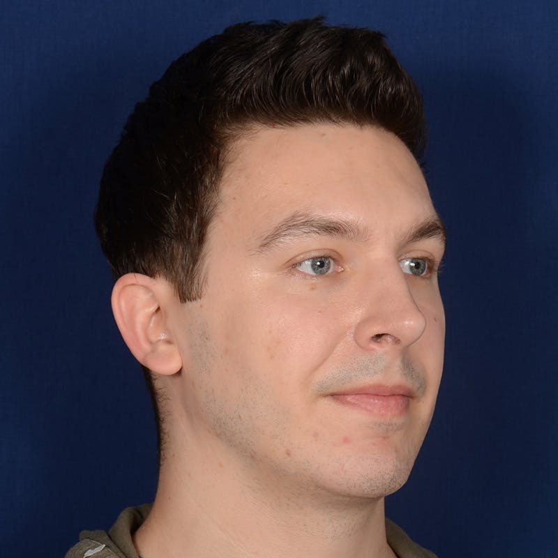 Chin Augmentation Before & After Gallery - Patient 363118 - Image 4