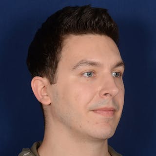 Chin Augmentation Before & After Gallery - Patient 363118 - Image 4