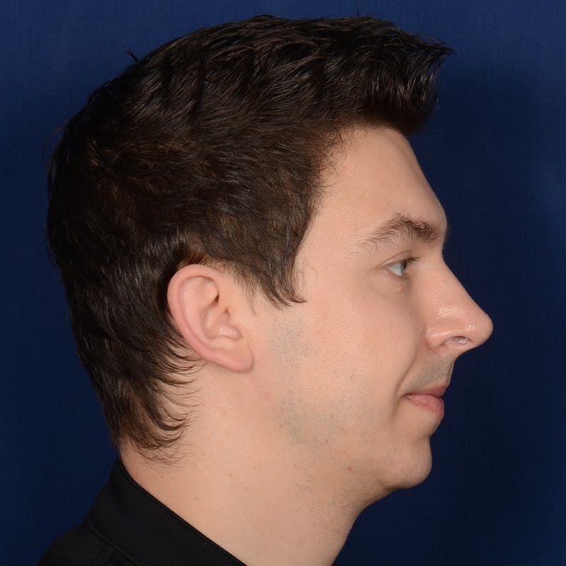 Chin Augmentation Before & After Gallery - Patient 363118 - Image 5
