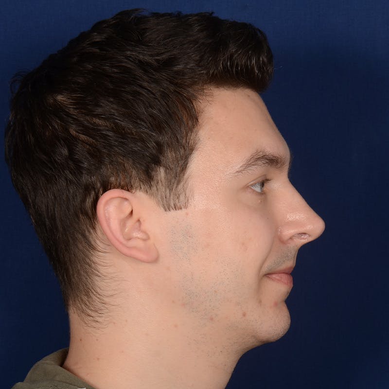 Chin Augmentation Before & After Gallery - Patient 363118 - Image 6