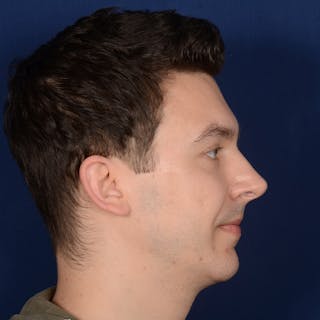 Chin Augmentation Before & After Gallery - Patient 363118 - Image 6