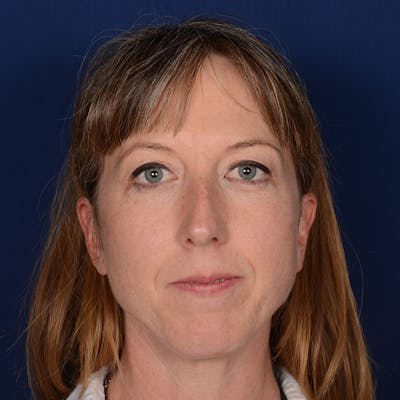 Chin Augmentation Before & After Gallery - Patient 332064 - Image 1