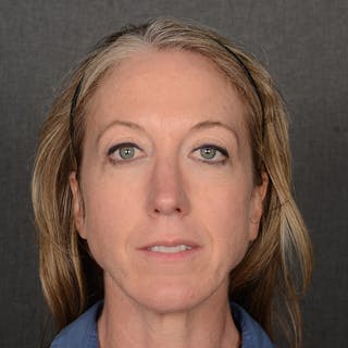 Chin Augmentation Before & After Gallery - Patient 332064 - Image 2
