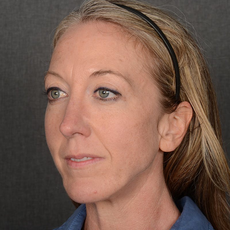 Chin Augmentation Before & After Gallery - Patient 332064 - Image 4