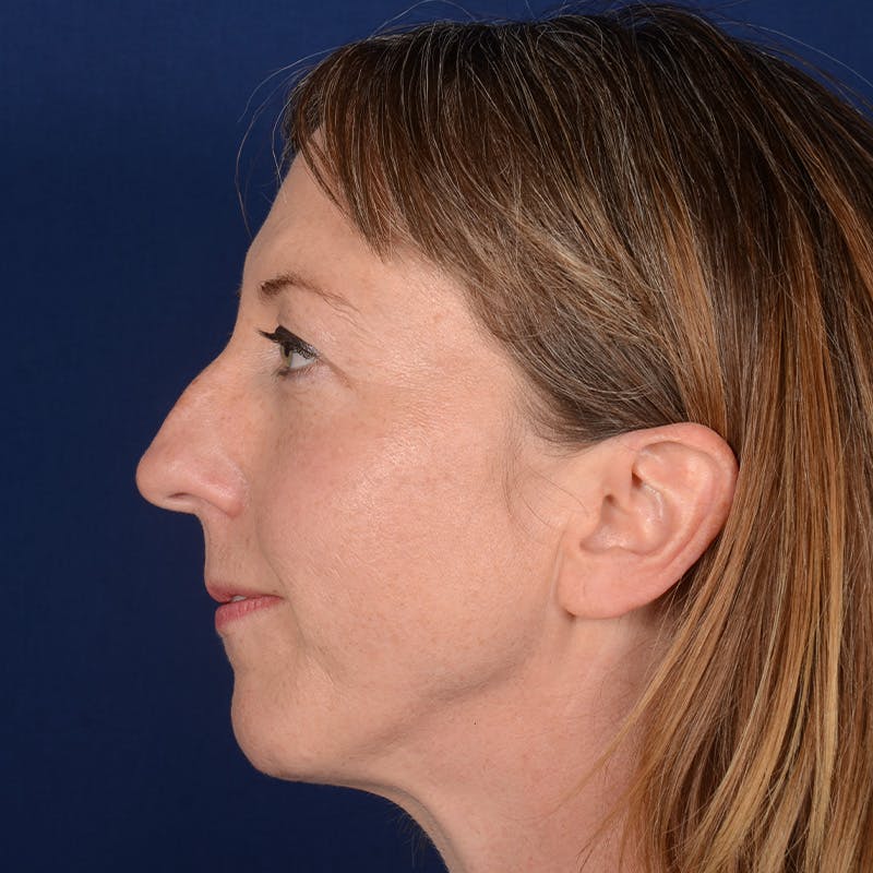 Chin Augmentation Before & After Gallery - Patient 332064 - Image 5