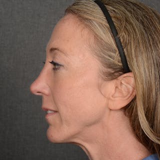 Chin Augmentation Before & After Gallery - Patient 332064 - Image 6