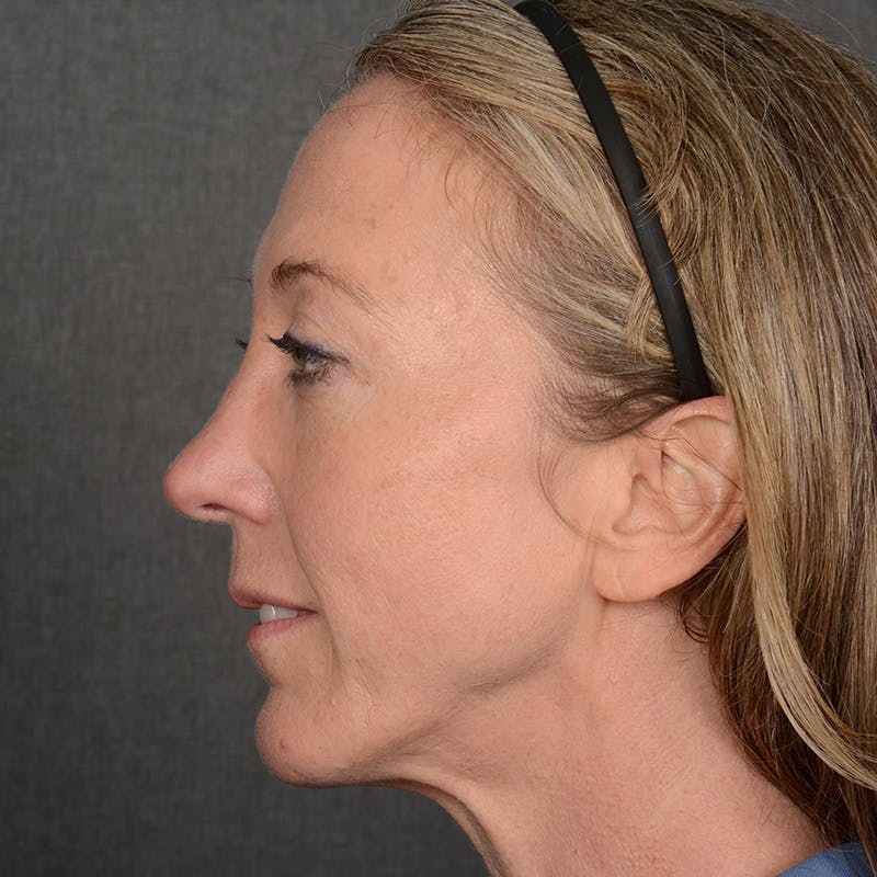 Chin Augmentation Before & After Gallery - Patient 332064 - Image 6