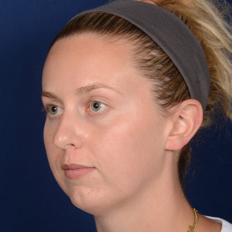 Chin Augmentation Before & After Gallery - Patient 230728 - Image 3