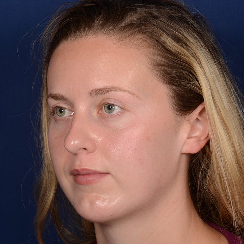 Chin Augmentation Before & After Gallery - Patient 230728 - Image 4