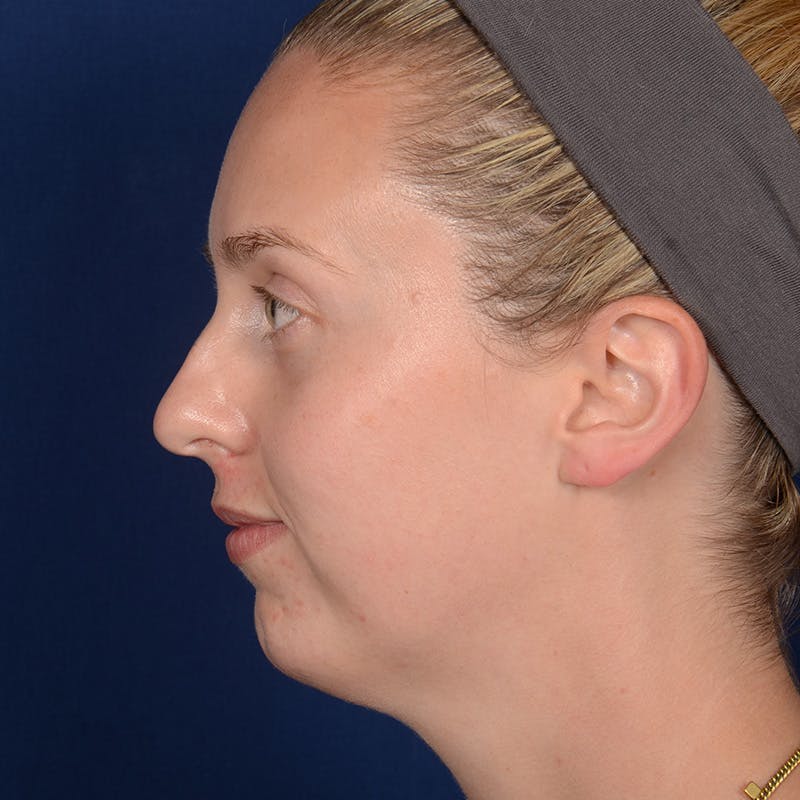 Chin Augmentation Before & After Gallery - Patient 230728 - Image 5