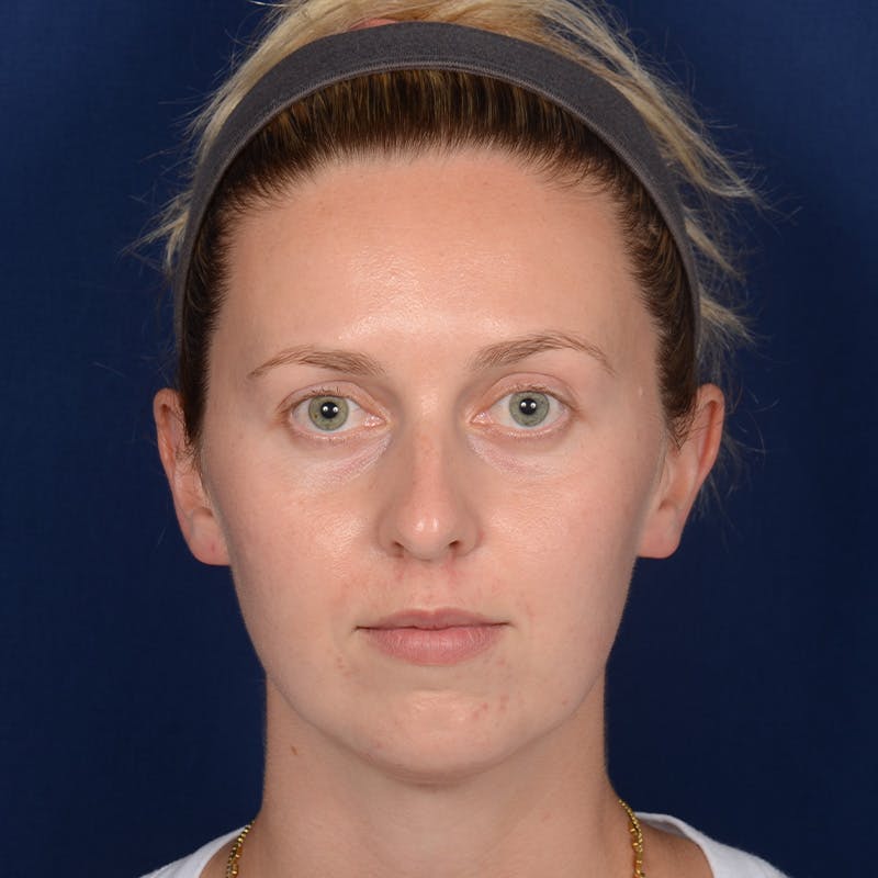 Chin Augmentation Before & After Gallery - Patient 230728 - Image 1