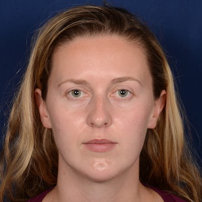 Chin Augmentation Before & After Gallery - Patient 230728 - Image 2