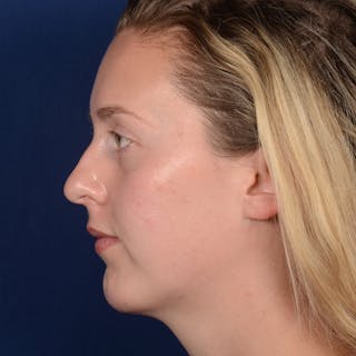 Chin Augmentation Before & After Gallery - Patient 230728 - Image 6