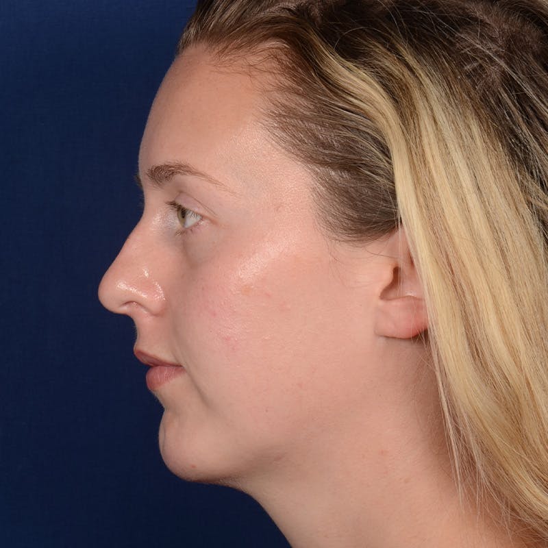 Chin Augmentation Before & After Gallery - Patient 230728 - Image 6
