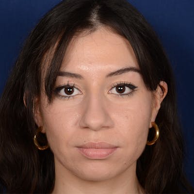 Chin Augmentation Before & After Gallery - Patient 312964 - Image 1