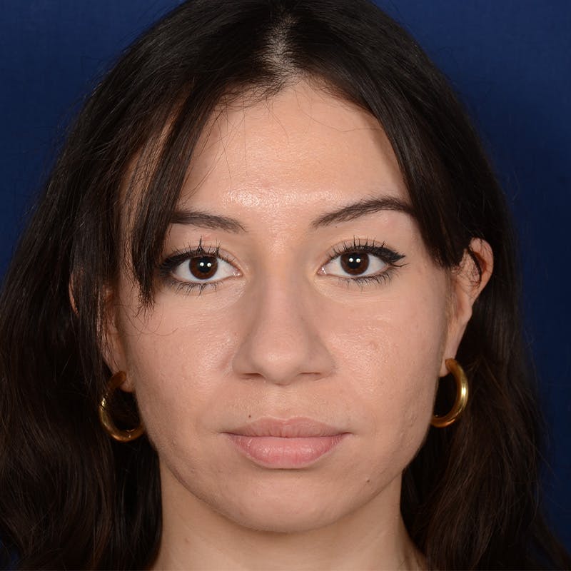 Chin Augmentation Before & After Gallery - Patient 312964 - Image 1