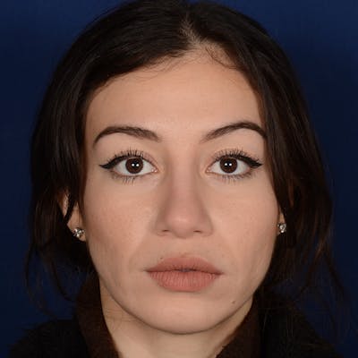 Chin Augmentation Before & After Gallery - Patient 312964 - Image 2
