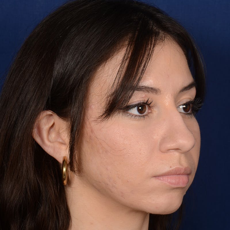 Chin Augmentation Before & After Gallery - Patient 312964 - Image 3