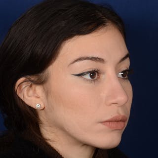 Chin Augmentation Before & After Gallery - Patient 312964 - Image 4