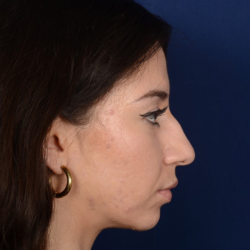 Chin Augmentation Before & After Gallery - Patient 312964 - Image 5