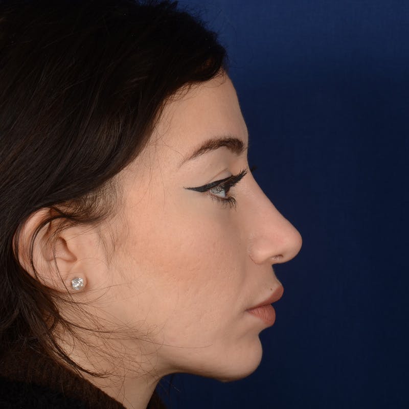 Chin Augmentation Before & After Gallery - Patient 312964 - Image 6