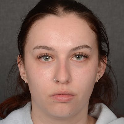 Chin Augmentation Before & After Gallery - Patient 939650 - Image 1