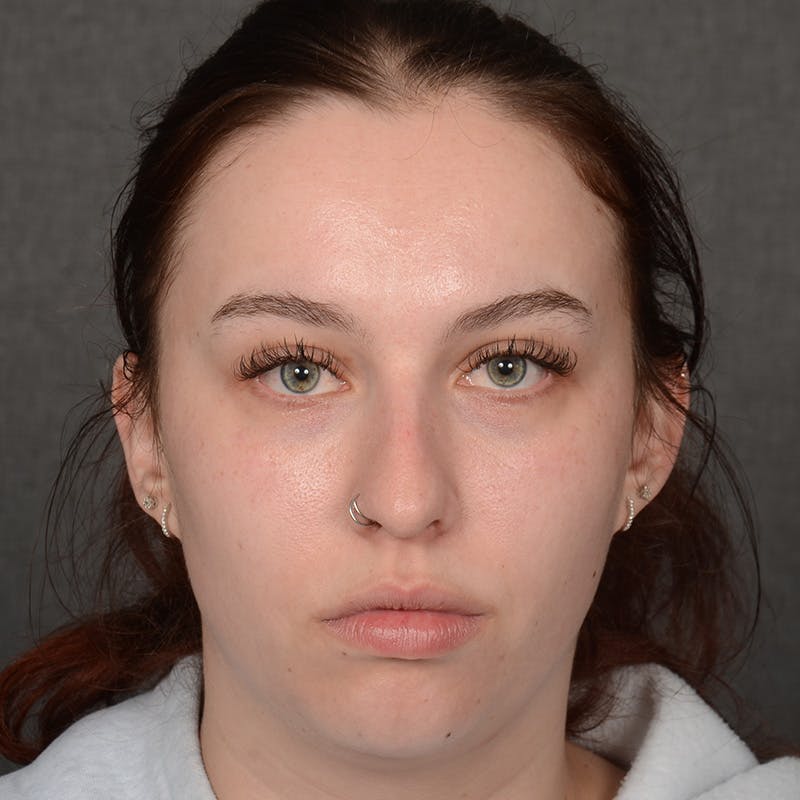Chin Augmentation Before & After Gallery - Patient 939650 - Image 1