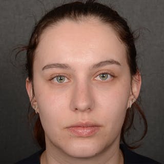 Chin Augmentation Before & After Gallery - Patient 939650 - Image 2